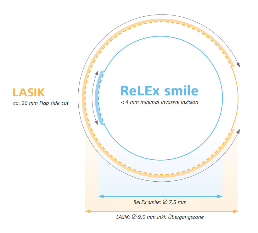 Grafische Darstellung von LASIK-Flapschnitt sowie den Korrekturzonen bei LASIK und ReLEx SMILE  lightbox