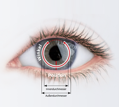 Bild eines Auges, in das Intracorneale Ringsegmente eingezeichnet sind.