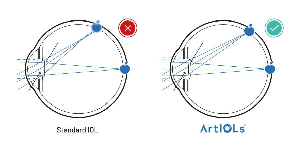 Illustration of how the ArtIOL intraocular lens with extended depth of focus works.