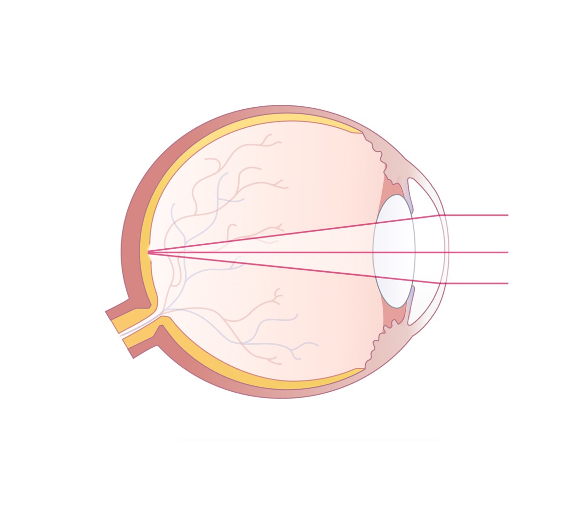 Kurzsichtiges Auge nach einer Augenlaserkorrektur mit Darstellung der einfallenden Lichtstrahlen, die sich nun auf der Netzhaut bündeln.