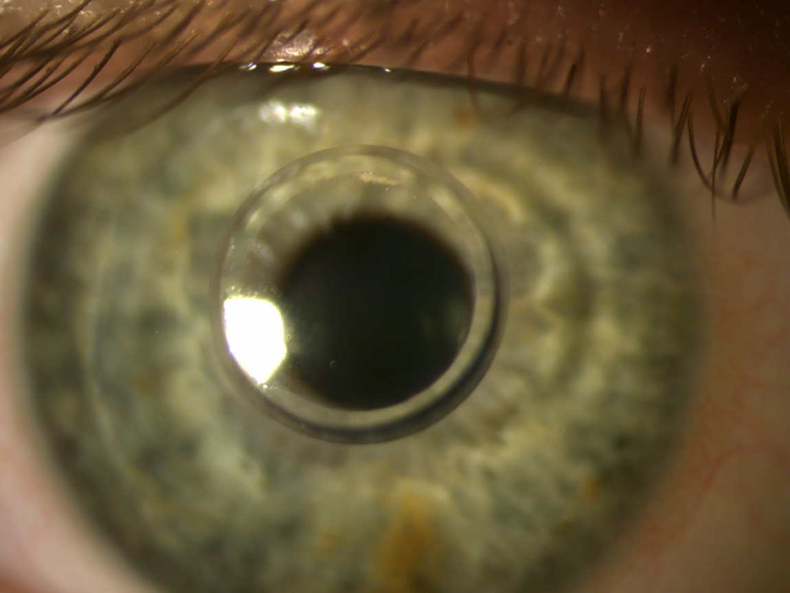 Stärkere Vergrößerung eines Auges mit einem Myoring.