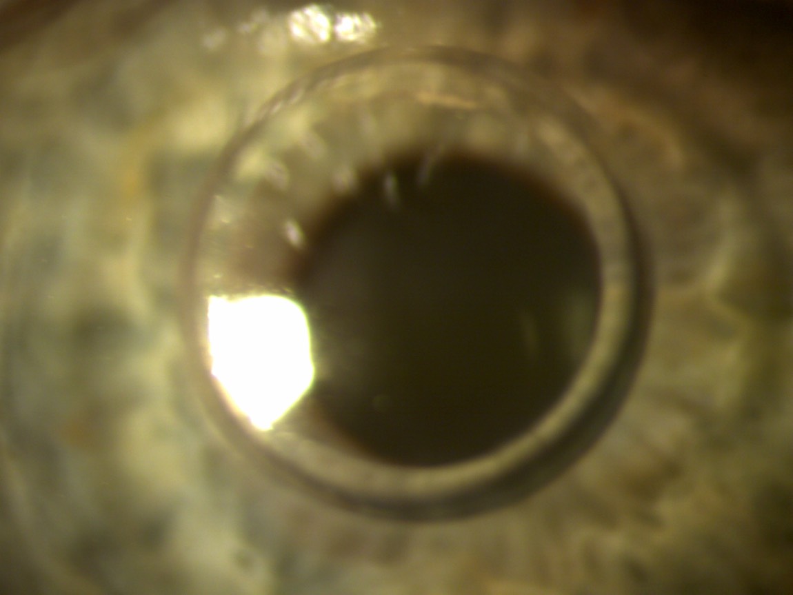 Weitere Vergrößerung mit Blick auf die Pupille eines Auges mit einem Myoring.