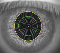 Aberrometrie des Auges