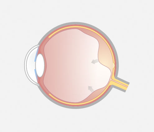 Grafische Darstellung eines Auges im Querschnitt mit hinterer Ablösung des Glaskörpers an zwei seitlichen Anheftstellen.