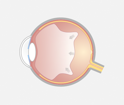Grafische Darstellung eines Auges im Querschnitt mit vollständiger hinterer Ablösung des Glaskörpers.