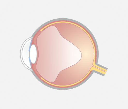 Grafische Darstellung eines Auges im Querschnitt mit vollständiger Ablösung des Glaskörpers.