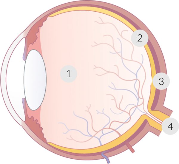 grafische Darstellung des Auges mit Markierung der Netzhaut