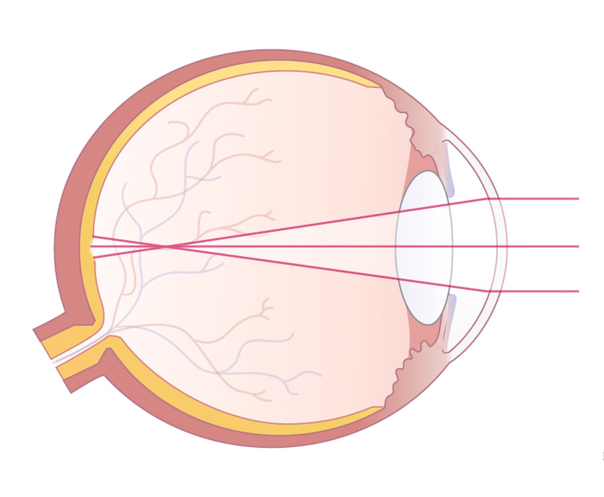 Illustration eines kurzsichtigen Auges mit Darstellung des Strahlengangs des einfallenden Lichtes.