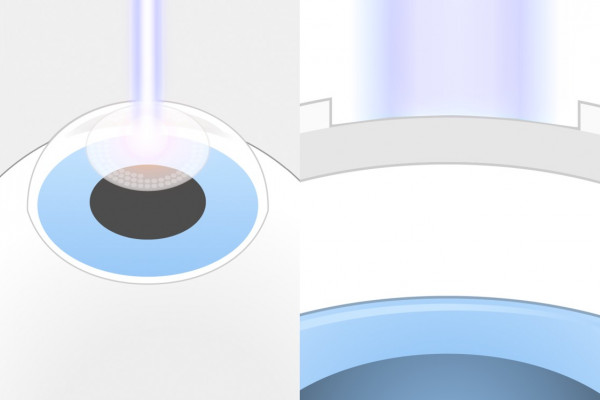 TransPRK Augenlasern Schritt 1 
Vergrößerung und Seitenansicht: Rechts sieht man, dass der Laser erst die oberste Schicht, das Epithel, entfernt und anschließend das darunter liegende Hornhautgewebe formt.