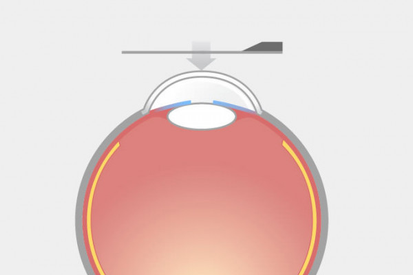 LASIK-Grafik, Schritt 1: Zur Fixierung saugt ein Ring das Auge mit Vakuum an und flacht die Hornhaut ab.