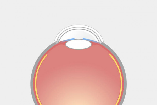 SMILE-Grafik, Schritt 2: Das anatomisch geformte Kontaktglas liegt komplett auf und fixiert das Auge sicher während der Laserbehandlung.