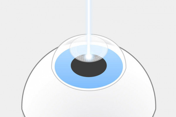 SMILE-Grafik: Der Femtosekundenlaser VISUMAX präpariert das Lentikel mit kleinsten Gasbläschen per 3-D-Laserschnitt im Inneren der Hornhaut in ca. 10 Sekunden / Auge.