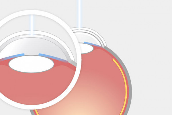 Grafik zum SMILE-Augenlasern: Seitenansicht des Auges beim Laservorgang mit dem Femtosekundenlaser. In der Lupenansicht der Hornhaut ist das Lentikel angedeutet.