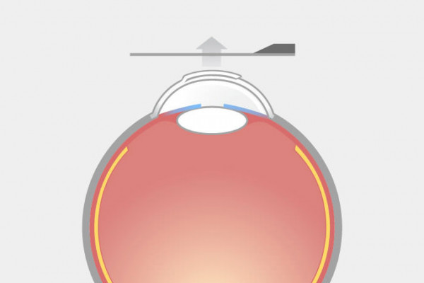 LASIK-Grafik, Schritt 5:
Das Mikrokeratom wird zurückgefahren und anschließend zusammen mit dem Saugring vorsichtig vom Auge entfernt, um einen Flapabriss zu vermeiden.