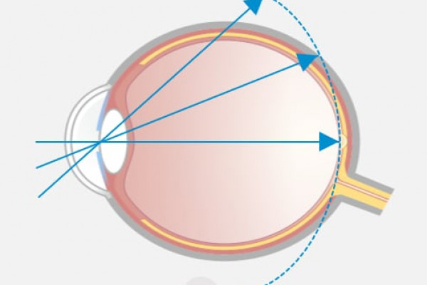 Korrektur der Kurzsichtigkeit mit Einstärken-Brille: Einstärkegläser korrigieren Kurzsichtigkeit so, dass die Schärfenebene (1) genau auf die Netzhautmitte fällt, in der gesamten Peripherie jedoch dahinter (hyperoper Defokus) liegt.