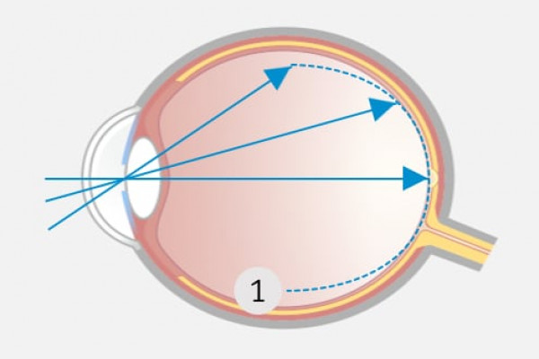 Innovative Korrektur der Kurzsichtigkeit: Die Schärfenebene liegt im Zentrum genau auf der Netzhaut und in der äußeren Peripherie davor (myoper Defokus).