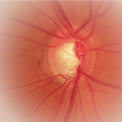 International Council of Ophthalmology bestätigt Sinn der Glaukom-Früherkennung