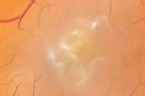 Teaserfoto Macular Pucker (Epiretinale Gliose)