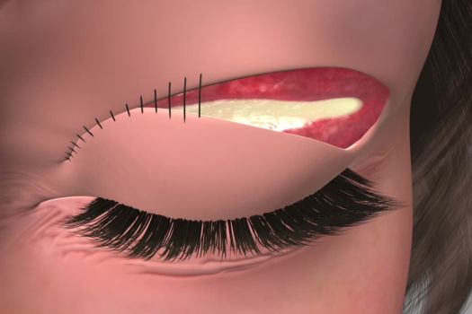 Teaserbild [Echo] Blepharoplastik