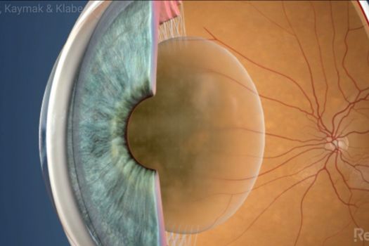 Teaserbild [Echo] Cataracts Symptoms