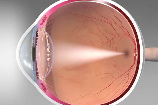 Teaserbild [Echo] Cataracts Treatment Overview