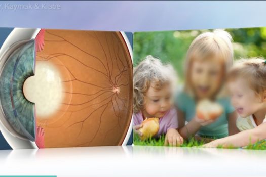 Teaserbild [Echo] Cataracts Treatment Overview