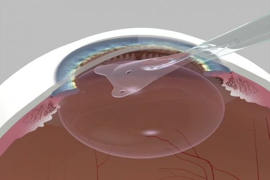 Teaserbild [IKONION] ICL Implantation