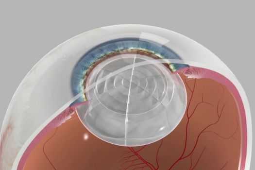 Teaserbild [Echo] Cataracts Overview
