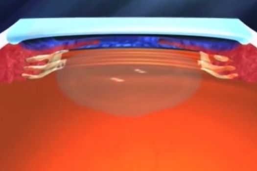 Teaserbild [Vimeo] 360°-Canaloplasty: Einführung